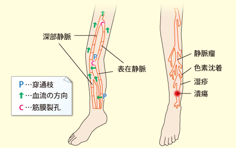 下肢静脈瘤の説明画像
